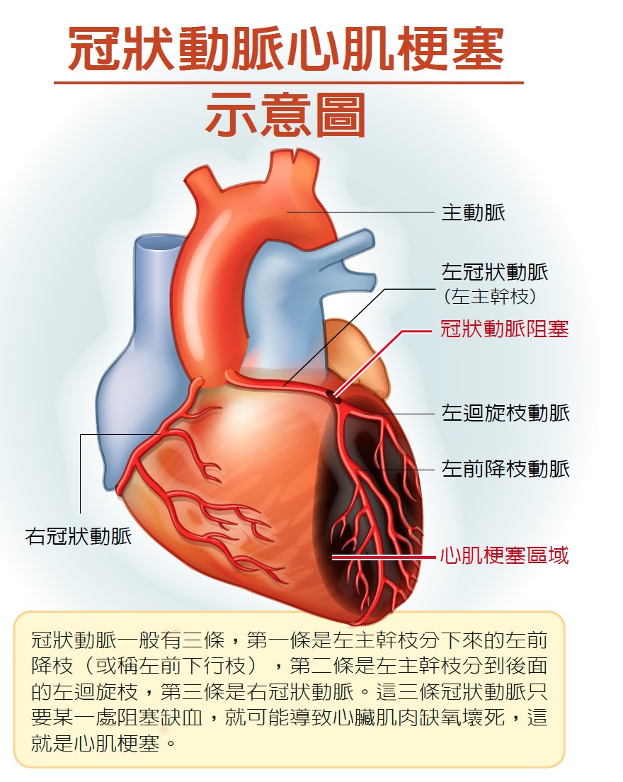 胸悶胸痛！ 把握心肌梗塞黃金搶救時間！ - 第36期 - 健康刊物 | 全民健康基金會